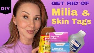 Get Rid of Milia & Skin Tags: At Home