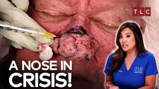 A Patient's 20-Year Battle with Nose! | Dr Pimple Popper - TLC