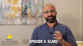 Episode 5: Scar Treatment | الحلقه الخامسة: علاج اثار الجروح و الندبات