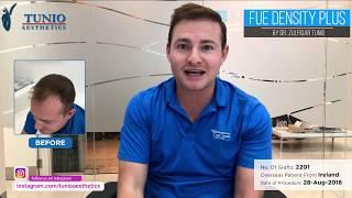 Client From Ireland Sharing His FUE Hair Transplant Experience After 10 Months of Procedure