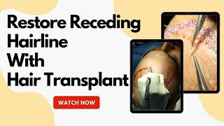 Restoring Receding hair line with hair transplant | Tamiralife