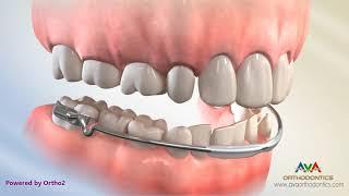 Orthodontic Space Management - Lip Bumper Appliance