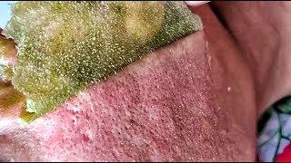 Blackhead Removal Using Mask in Asia/Blackheads Removal