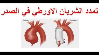 ما هو تمدد الشريان الاورطي في الصدر ؟ ما هي اعراض و تشخيص و طرق علاج تمدد الشريان الابهري الصدري