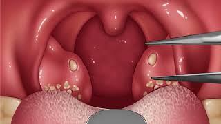 Tonsil stone removing| How to care about bad smell | ASMR tonsil stone removing