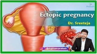 Ectopic Pregnancy : Etiology, Clinical features, Diagnosis, Treatment and Complications : Gynecology