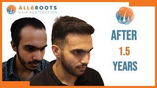 Amazing Hair Transpalnt Results after 1.5 Years | Hair Transplant by Dr Alok Sahoo | Alloroots