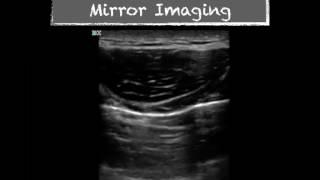 Ultrasound Physics Imaging Artifacts