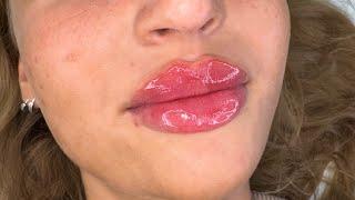 Russian lip filler technique (shortened)