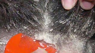 Dandruff scratc3ing removal on head using black combing#1390