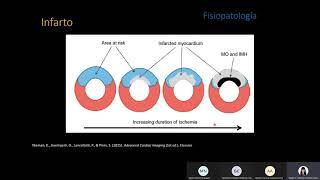 Miocardiopatía isquémica Dr. Ulises Longoria Estrada