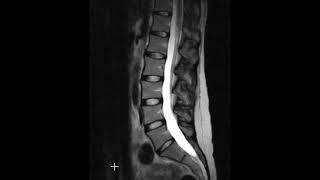Lumbar spine disc herniations
