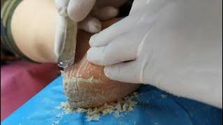 Cracked heel treatment #2 Very thick dead skin removal and hard skin treatment. Callus removal.