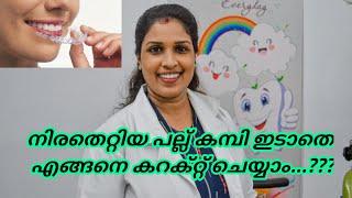 ക്ലിയർ അലൈനേഴ്സ്, പല്ലിൽ കമ്പിയിടാതെ തന്നെ നിരതെറ്റിയ പല്ലുകൾ നേരെയാക്കാം..