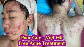 Poor Guy I Cystic Acne TreatmentI Điều trị mụn miễn phí Hiền Vân Spa I Huỳnh Việt Hồ sau 2 buổi I508