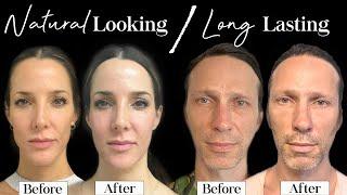 Sculptra Before and After | The Sculptra GLOW  | Avoid the Pillow Face