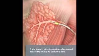 Sialendoscopy