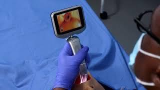 Insighters® iS6 Handheld Video Laryngoscope System - Instructional Video