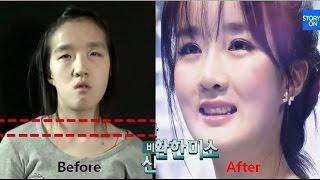 LET ME IN 5 Mommy make over to a doll (Korean Plastic Surgery Before & After, Jaw Surgery)