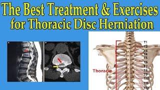 The Best Natural Treatment and Exercises for Thoracic Disc Herniation - Dr Mandell