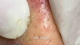 ACNE TREATMENT ON THE FACE | LOAN NGUYEN