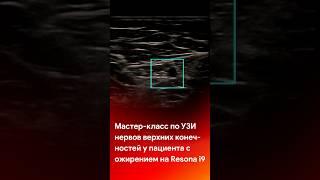 Мастер-класс по УЗИ нервов верхних конечностей у пациента с ожирением #shorts #short #tiktok #reels