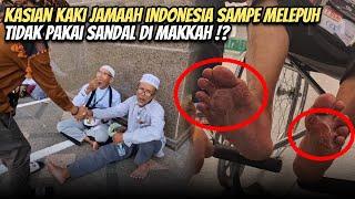 INILAH YANG TERJADI DENGAN JAMAAH HAJI INDONESIA KAKINYA MELEPUH PANAS