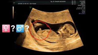 How is fetal gender determined on ultrasound. 14th week in the womb. Guess: Is it a boy or a girl?