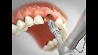 Implantes dentários Clínica Odontowicz