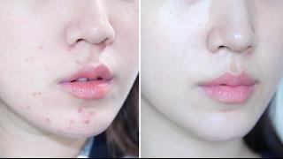 How To Get Rid Of Acne Naturally | Skin Transformation  Liah Yoo