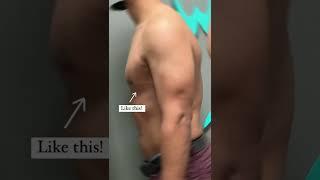 Gynecomastia surgery by Dr. Lyly at 6 weeks post-op