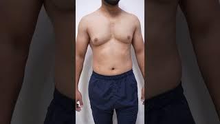 Gynecomastia Surgery before & After #shorts #ytshorts