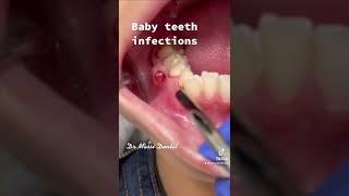 Dental Fistula, baby teeth infection #video #trending #tiktok #viral #shorts #youtubeshorts #shorts