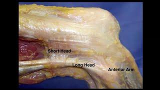 Posterolateral Approach Knee | Depressed Posterolateral fragment | Traumacon 24