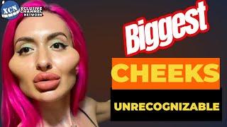 Woman With Worlds Biggest Cheeks Is Unrecognizable | XCN