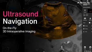 Brainlab Ultrasound Navigation – On-the-Fly Intraoperative 3D Imaging with BK Medical