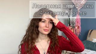 Лазерная Шлифовка Лица | Спустя 4 месяца. Как изменилась кожа после Лазера Co2