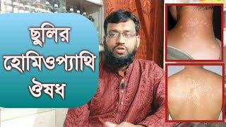 ছুলির হোমিওপ্যাথি ও বায়োকেমিক ঔষধ || Tinea versicolor homeopathy treatment in bangla