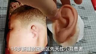 在中国贫困的新疆地区义耳改变了他的生活In the impoverished Xinjiang region of China, the prosthetic ear changed his life