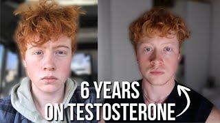 6 YEARS ON TESTOSTERONE | FTM TRANSGENDER