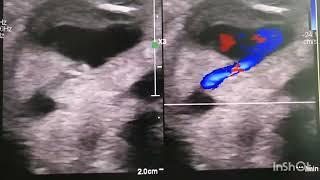 Heart shaped false aneurysm from the radial artery after coronary angiography