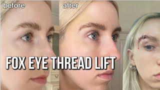 My Fox Eye Thread Lift *what they don't tell you*