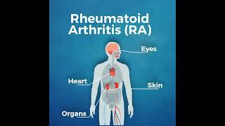 Chronic Conditions: Understanding Arthritis and its Symptoms | #shorts