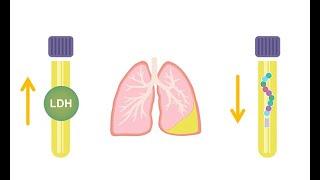 Differentiating transudative and exudative effusions transudate vs  exudate