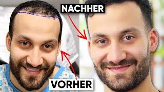 Haarausfall gestoppt und wieder volle Haare | 11 Monate nach der Haartransplantation mit Stammzellen