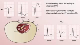 Intro to EKG Interpretation - Bundle Branch Blocks