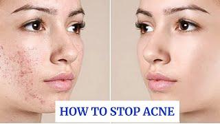 8 Secrets To Keep Your Face Acne Free