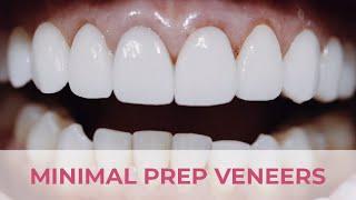 Porcelain Veneers Smile Transformation Minimal Preparation | Dental Boutique