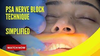 PSA Nerve Block Simplified