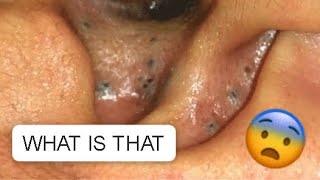 UNBELIEVABLE !!! AN EAR FULL OF BLACKHEADS... SATISFYING VIDEO #2 #relaxing #blackheads